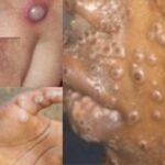 UFAHAMU Ugonjwa wa MPOX na Jinsi ya Kujikinga