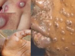 UFAHAMU Ugonjwa wa MPOX na Jinsi ya Kujikinga